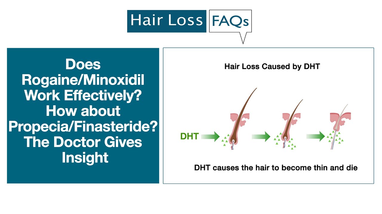 You are currently viewing Does Rogaine/Minoxidil Work Effectively? How about Propecia/Finasteride?
