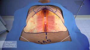 Read more about the article Dr Claytor demonstrates tummy tuck with liposuction 3 D animation: No Drains