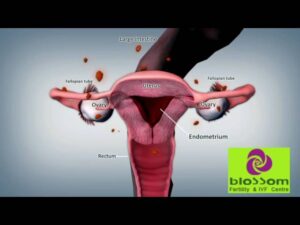 Read more about the article Endometriosis and Infertility – a #woman’s guide to this painful disease