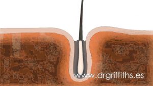 Read more about the article FUE Hair Transplant – Animation