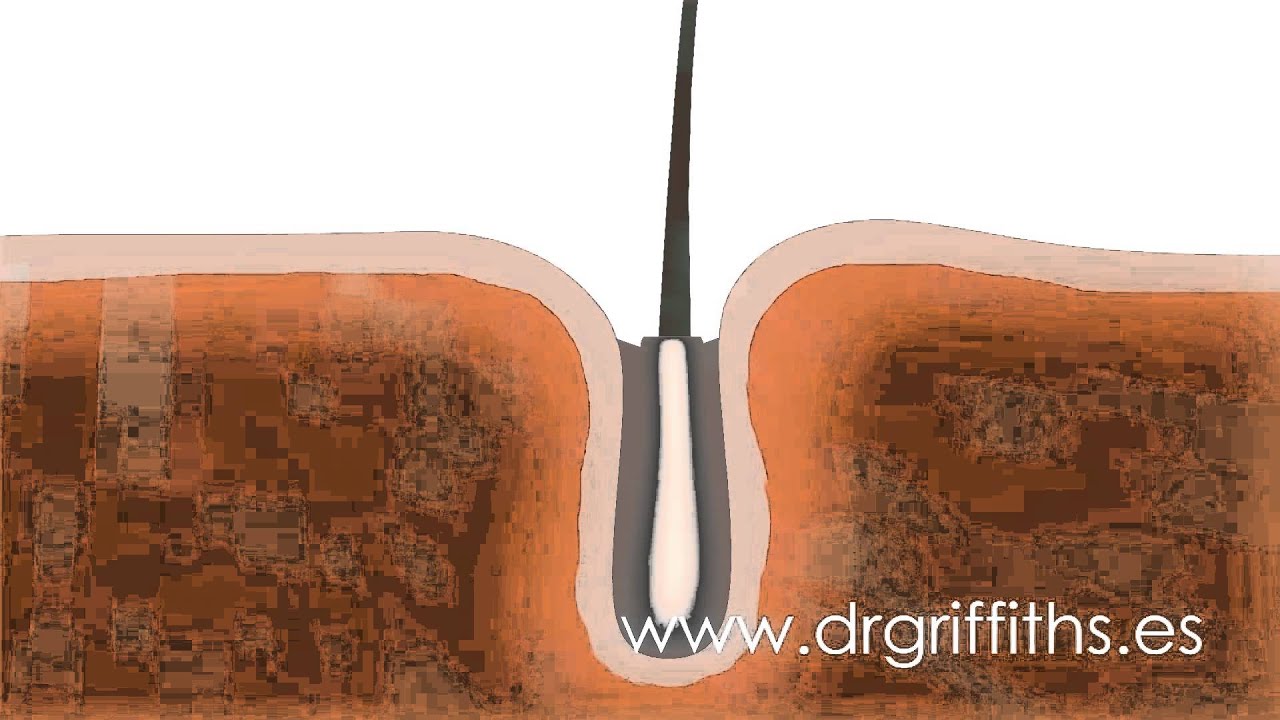 You are currently viewing FUE Hair Transplant – Animation