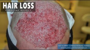 Read more about the article FUE Hair Transplant – Final Result Timeline – Hair loss treatment / baldness for Men 2016