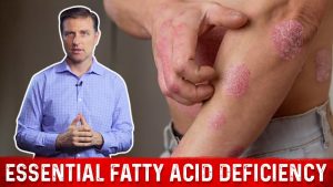 Read more about the article Fatty Acids (Omega 3 & Omega 6) Deficiency: Symptoms & Sources by Dr Berg