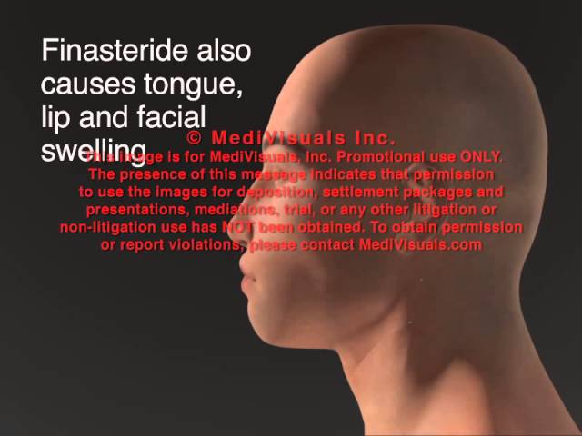 You are currently viewing Finasteride (Propecia & Proscar) Side Effects Animation