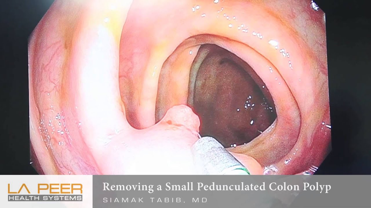 You are currently viewing Gastrointestinal Surgery Video – 4