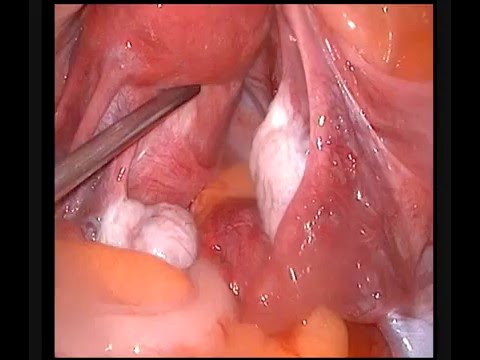 You are currently viewing Gynecological Surgeries Video – 5
