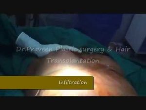 Gynecomastia | Dr. Praveen Kumar – Tirupati