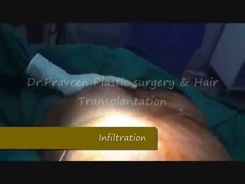 You are currently viewing Gynecomastia | Dr. Praveen Kumar – Tirupati