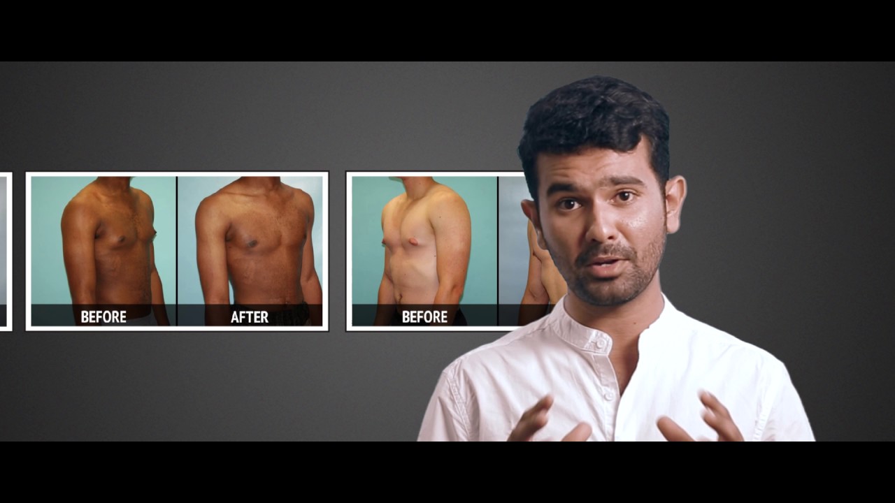 You are currently viewing Gynecomastia Male breast Correction