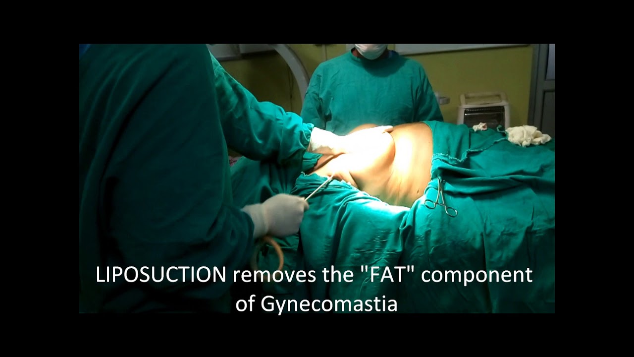 You are currently viewing Gynecomastia (Male breast) surgery- Dr Pranav Kumar- Patna, Bihar, India