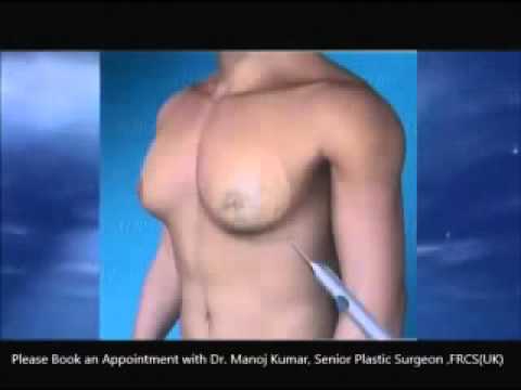 You are currently viewing Gynecomastia Surgery at Getwell Medical Center, Dubai