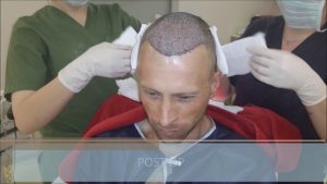 Read more about the article Hair Loss Treatment for Men / Male Pattern Baldness Treatment – FUE Hair Transplant Result