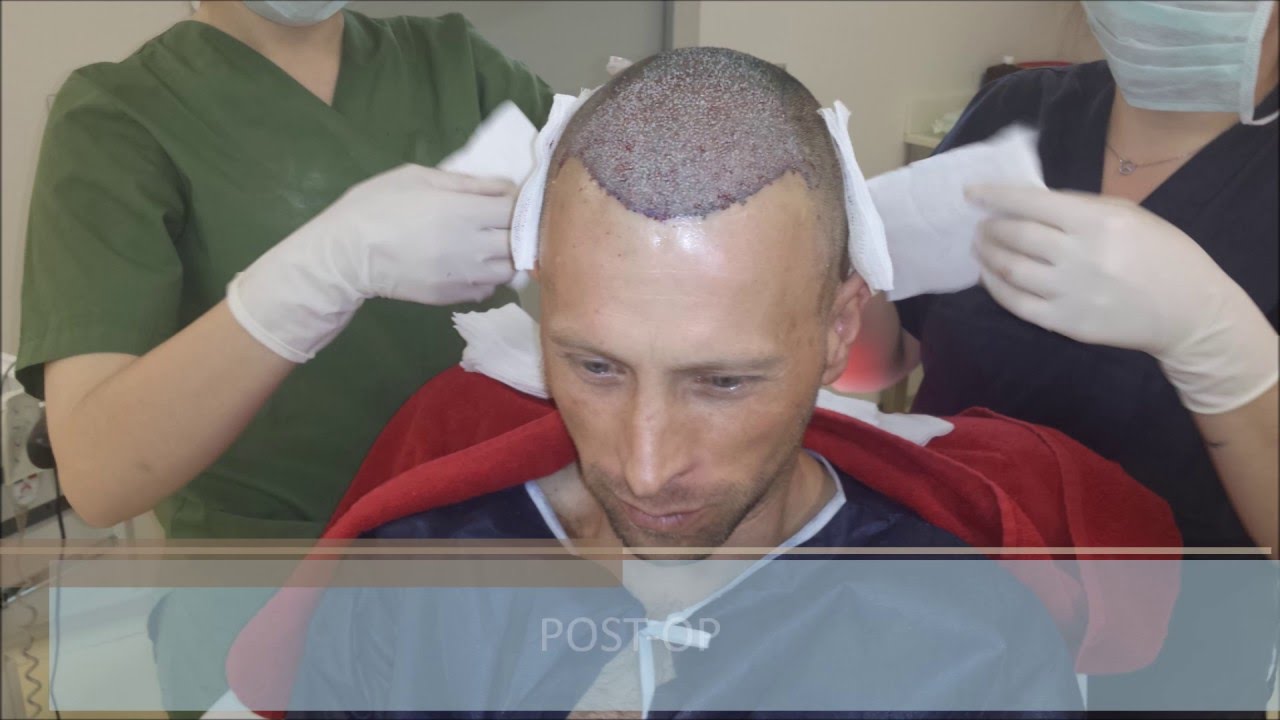 You are currently viewing Hair Loss Treatment for Men / Male Pattern Baldness Treatment – FUE Hair Transplant Result