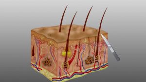 Read more about the article Hair Transplant 3d Animation
