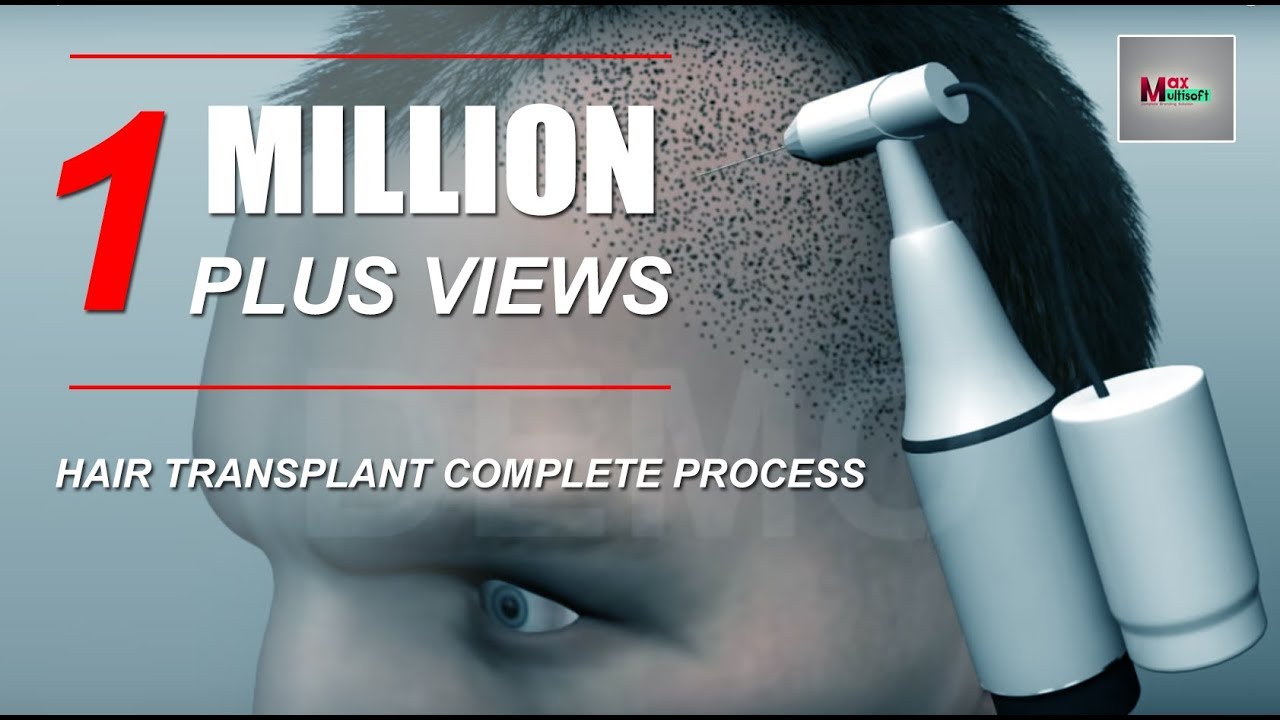 You are currently viewing Hair Transplant Complete Process 2020 3D Animation
