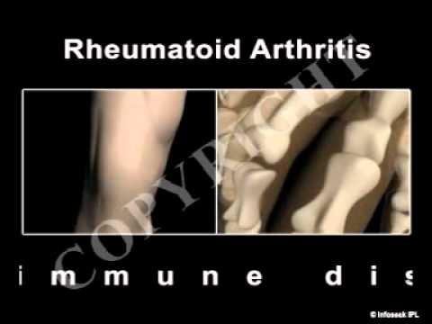 You are currently viewing Health Video on Arthritis (What is Arthritis?)