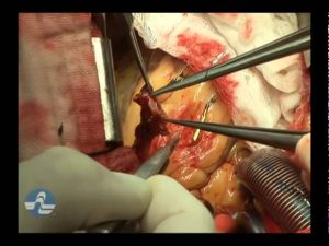 Read more about the article Heart Disease Treatment DVD –  Bypass surgery – Preview