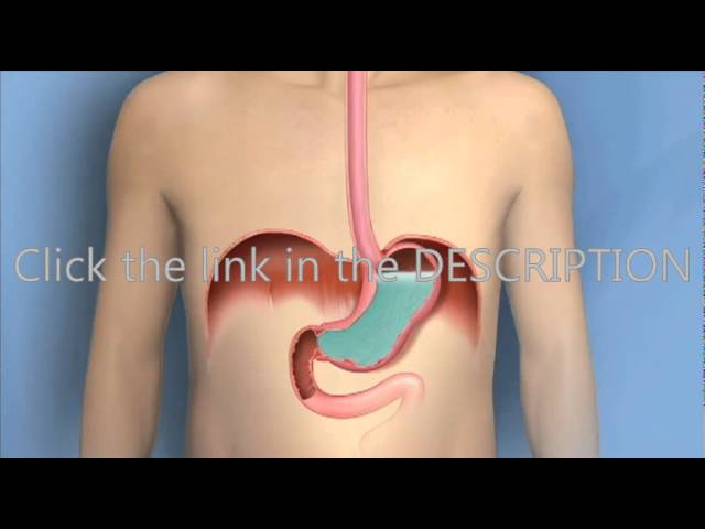 You are currently viewing Heartburn, Acid Reflux, GERD-Mayo Clinic