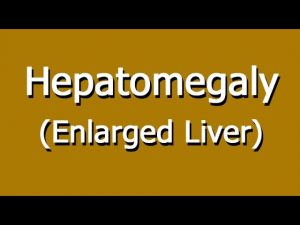 Read more about the article Hepatomegaly  – Enlarged Liver Causes, Symptoms, And Diagnosis