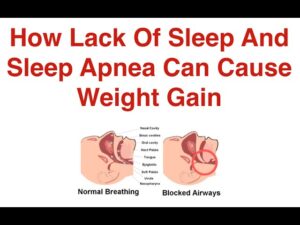 How Lack Of Sleep And  Sleep Apnea Can Cause Weight Gain