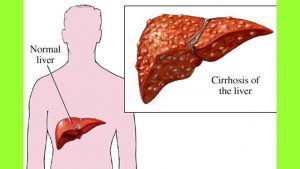 Read more about the article How To Cure Liver Cirrhosis Naturally | Liver Cirrhosis Natural Treatment | Liver Cirrhosis Diet
