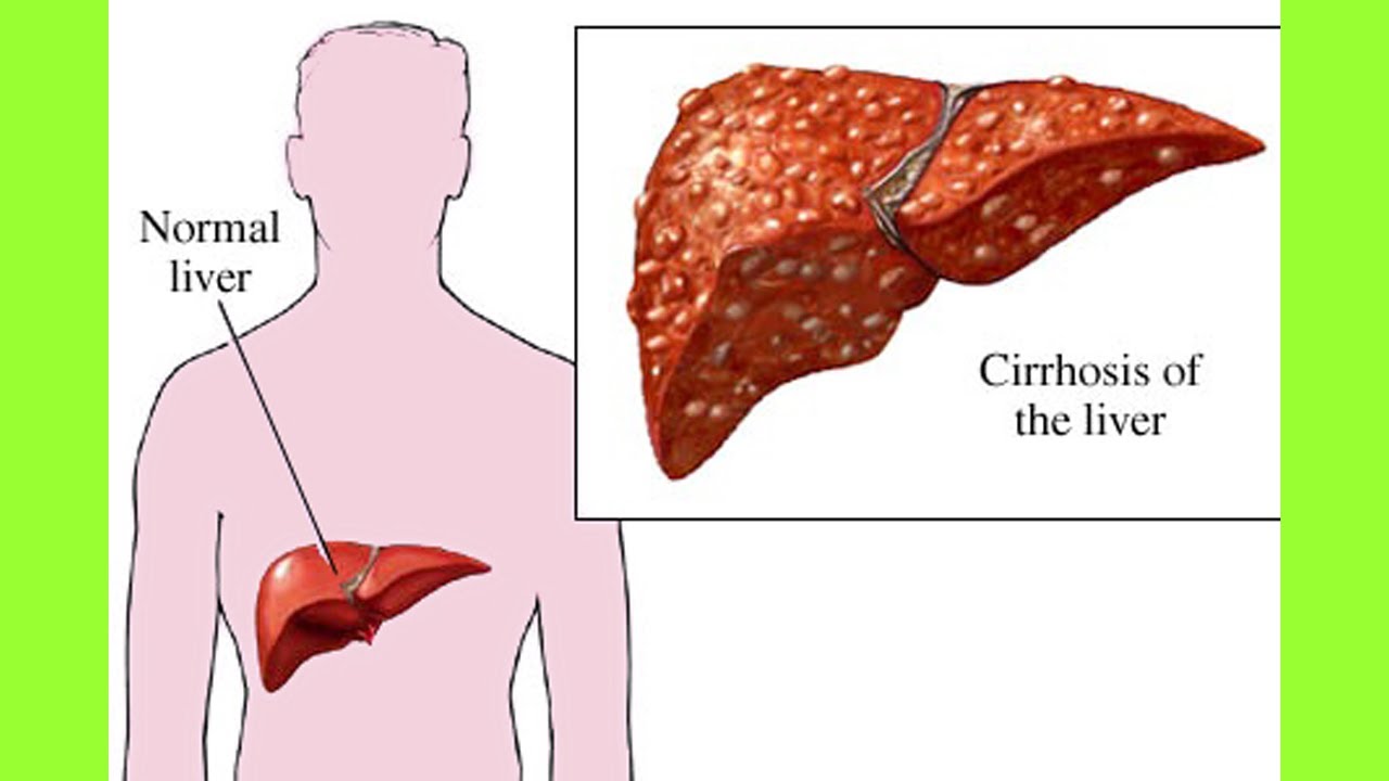You are currently viewing How To Cure Liver Cirrhosis Naturally | Liver Cirrhosis Natural Treatment | Liver Cirrhosis Diet