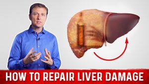 Read more about the article How To Repair Liver Damage After Alcohol?: Dr.Berg on Liver Cirrhosis