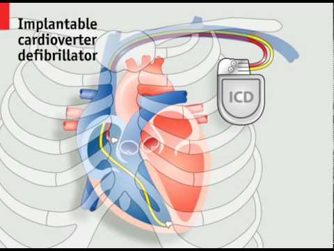 You are currently viewing How pacemakers work | The Economist