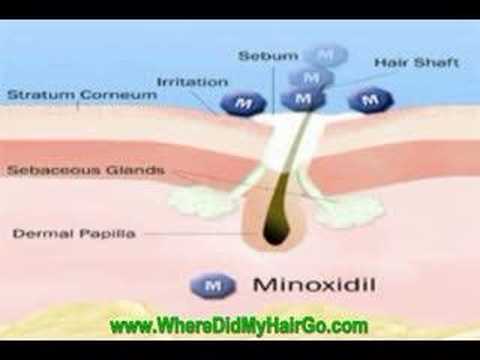 You are currently viewing How to Make Minoxidil (Rogaine) More Effective