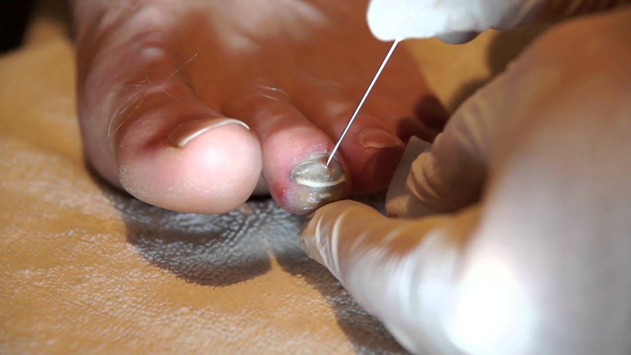 You are currently viewing How to drain a subungual hematoma (blood blister beneath the toenail)