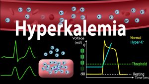 Hyperkalemia: Causes, Effects on the Heart, Pathophysiology, Treatment, Animation.