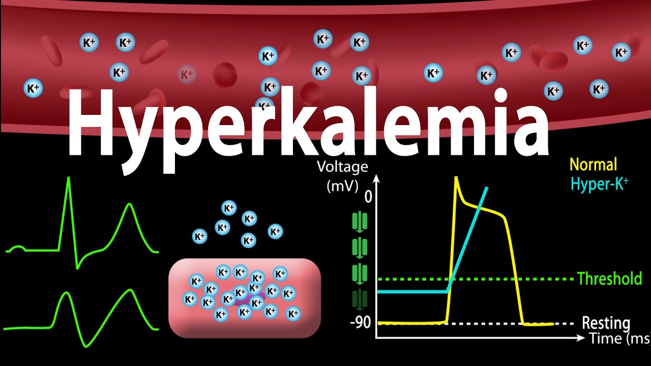 You are currently viewing Hyperkalemia: Causes, Effects on the Heart, Pathophysiology, Treatment, Animation.