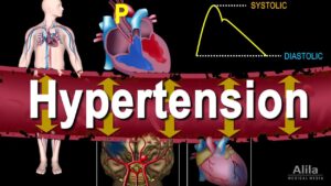 Hypertension – High Blood Pressure, Animation