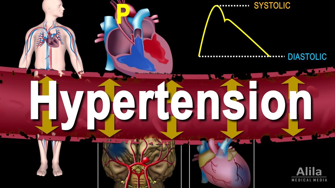 You are currently viewing Hypertension – High Blood Pressure, Animation