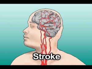 Read more about the article Hypertension and Stroke (Health Tip)