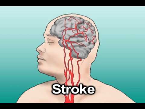 You are currently viewing Hypertension and Stroke (Health Tip)