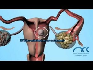 Read more about the article Hysterosalpingogram Procedure | Hysterosalpingogram Video – ARC Chennai