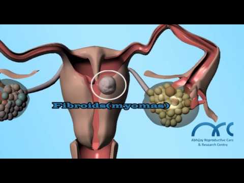 You are currently viewing Hysterosalpingogram Procedure | Hysterosalpingogram Video – ARC Chennai
