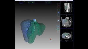 IQQA®-Liver for Virtual Liver Resection