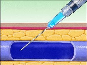 Read more about the article Improper IV Injection