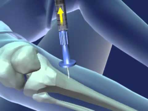 You are currently viewing Intraosseous Infusion.flv