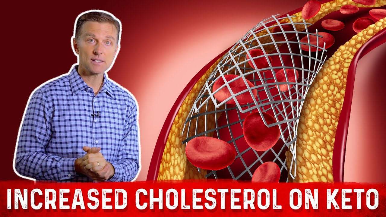 You are currently viewing Keto And Cholesterol: Why LDL Can Increase on Low Carb Diet | Dr.Berg