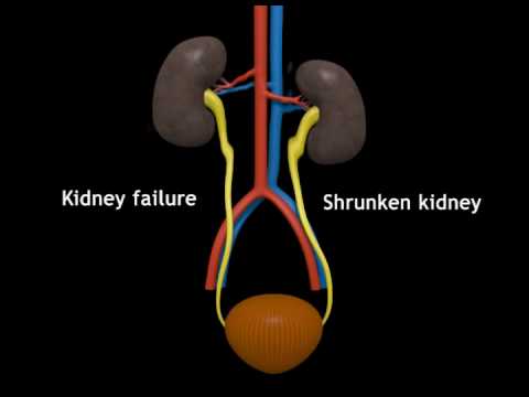 You are currently viewing Kidney Transpalantation animation.flv