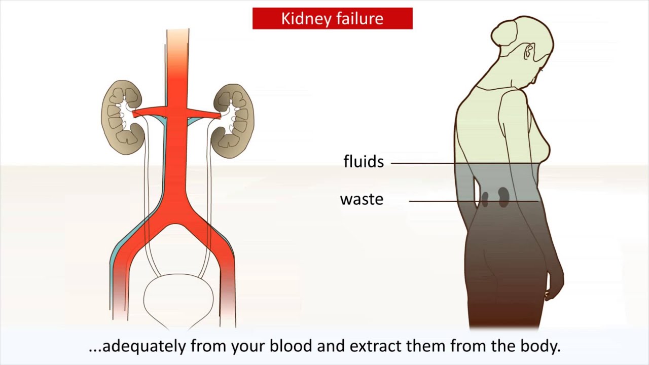 You are currently viewing Kidney disease – Causes and treatment of kidney failure