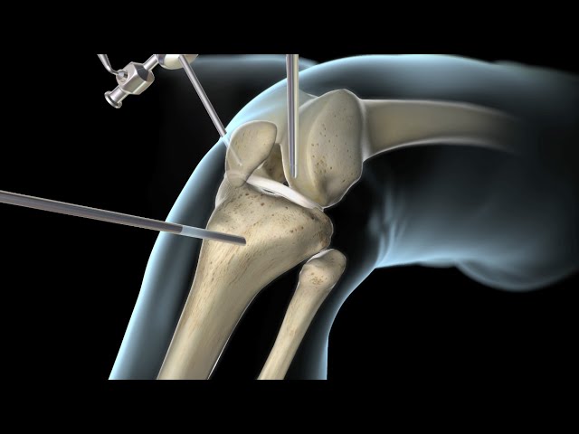 You are currently viewing Sports Surgeries Video – 2