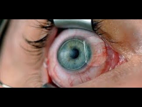 You are currently viewing Laser Surgeries Video – 5