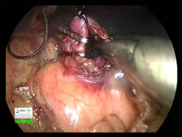 You are currently viewing Laproscopic Surgeries Video – 5