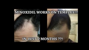 MINOXIDIL WORK ON TEMPLES IN JUST 2 MONTHS??!