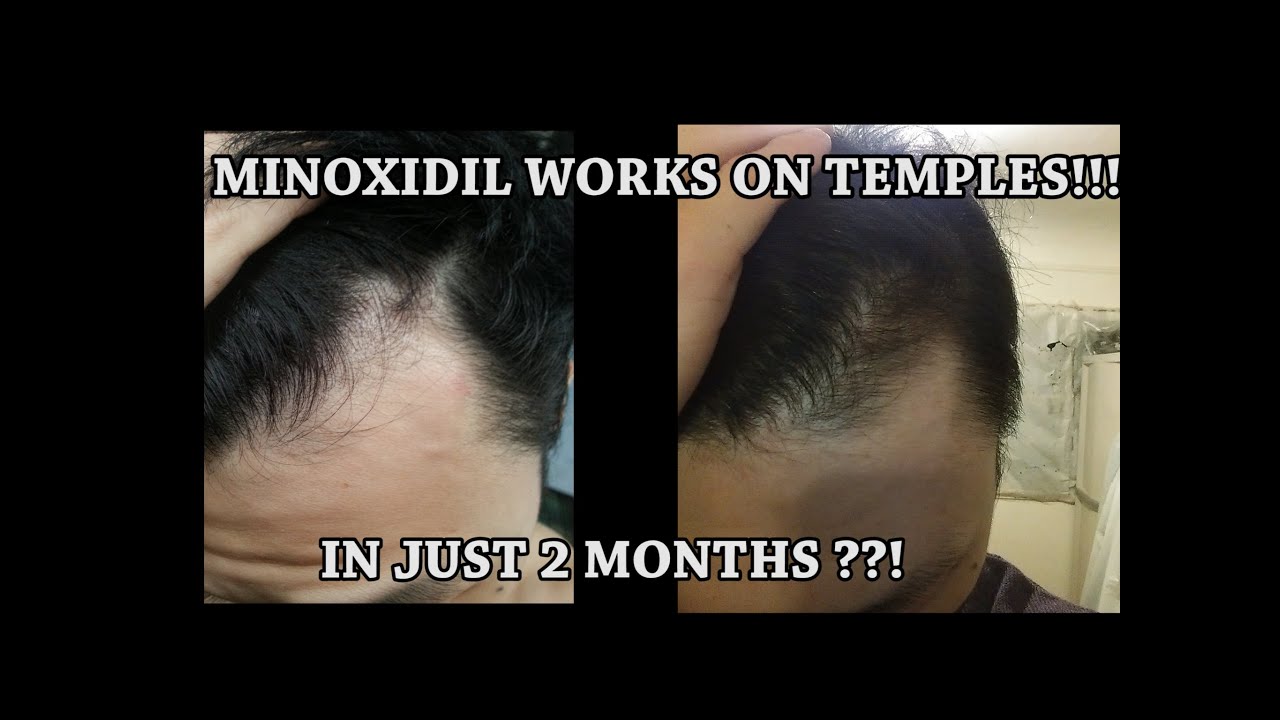 You are currently viewing MINOXIDIL WORK ON TEMPLES IN JUST 2 MONTHS??!