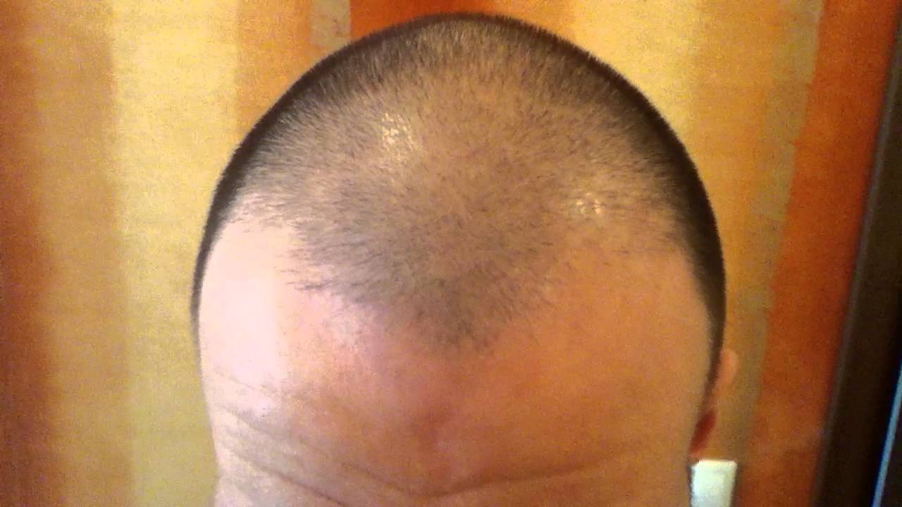 You are currently viewing Minoxidil Personal Science Test Using Rogaine 5% Day 36